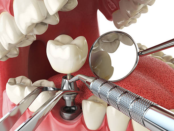 Best Emergency Root Canal Treatment in Stanton, CA